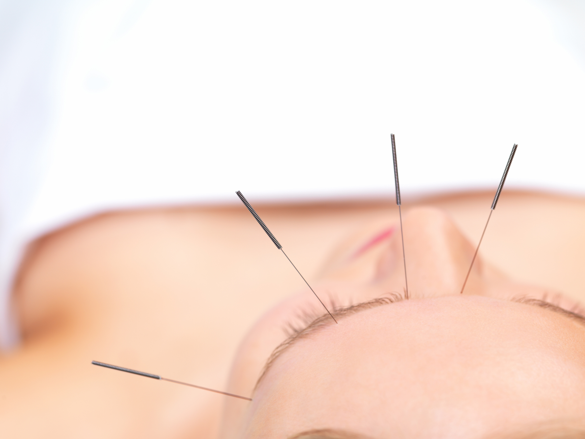 Beautiful young woman getting acupuncture therapy