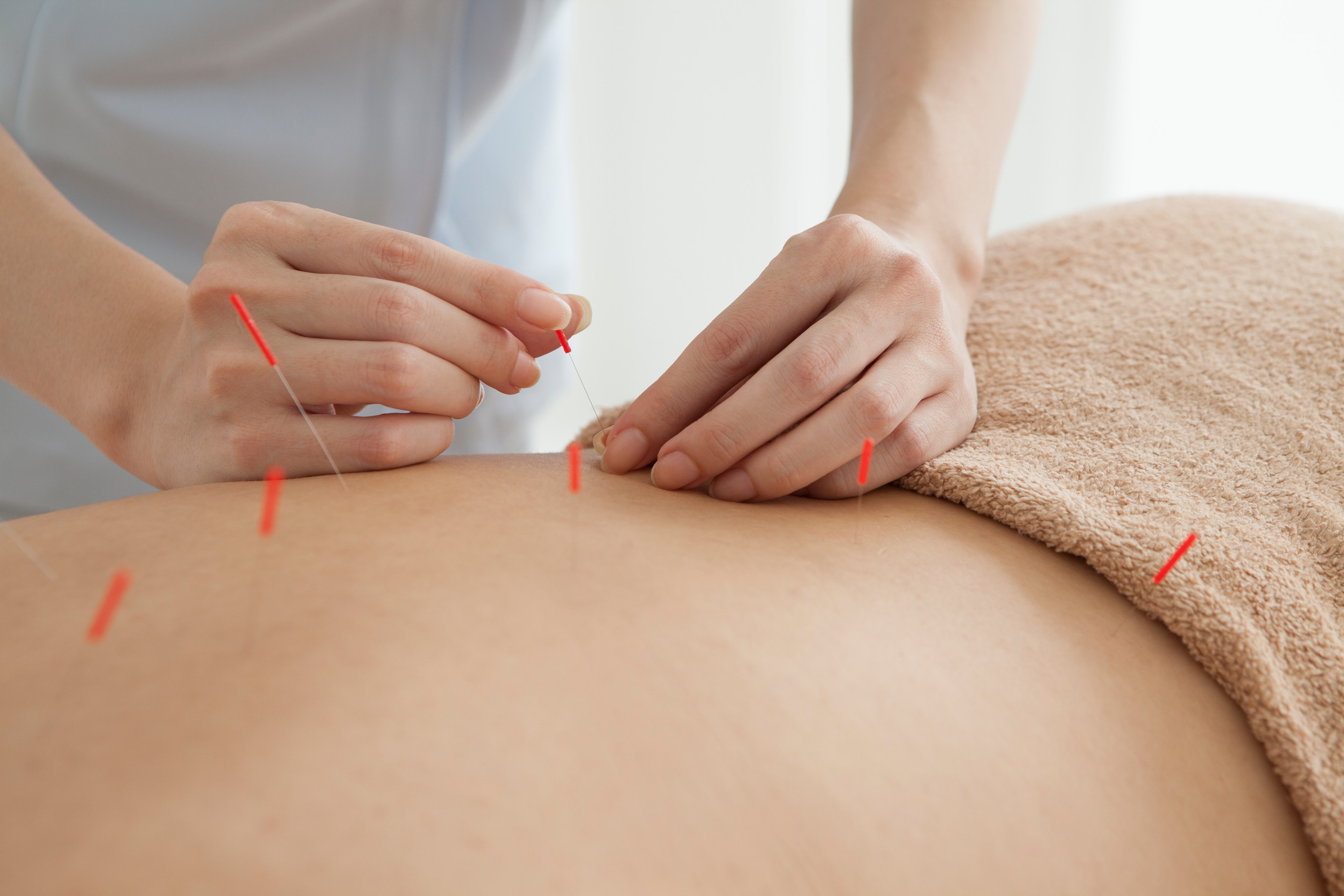 Acupuncturist is treating the woman Close-up of hands performing acupuncture on a person's back, with several fine needles inserted into the skin, covered partially by a beige towel.