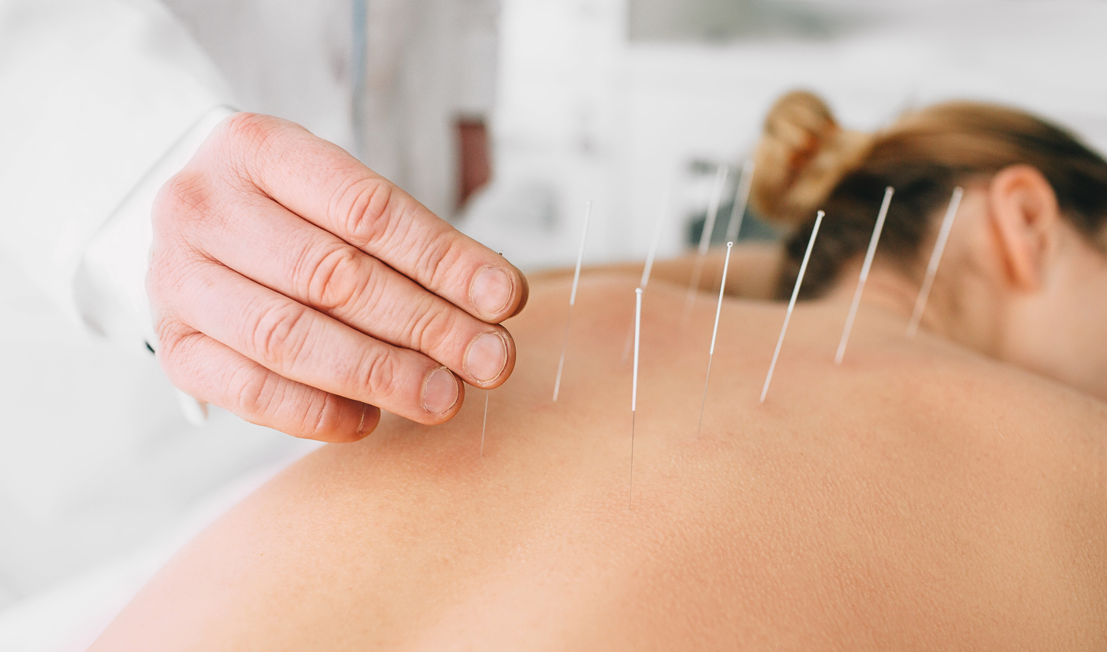 Woman having acupuncture treatment on her back A close-up of an acupuncturist's hand carefully placing thin needles into a woman's bare back during an acupuncture session. The patient lies face down with multiple needles inserted, highlighting the traditional Chinese medicine practice for pain relief and relaxation. Acupuncture for immune health.