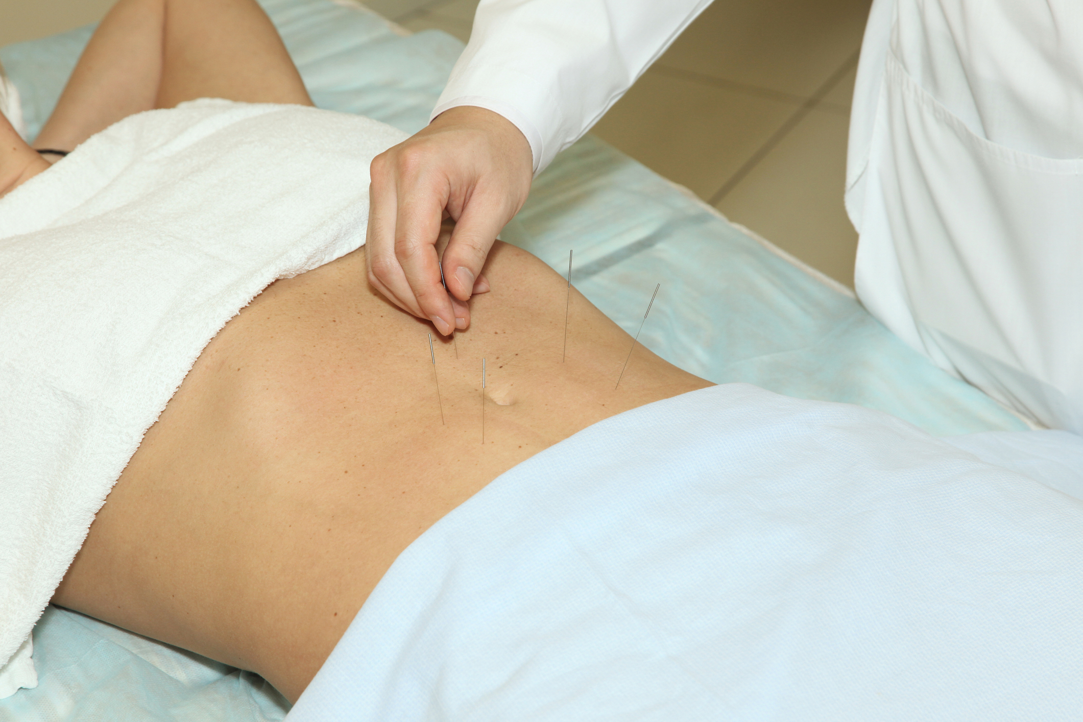Woman accept procedure acupuncture