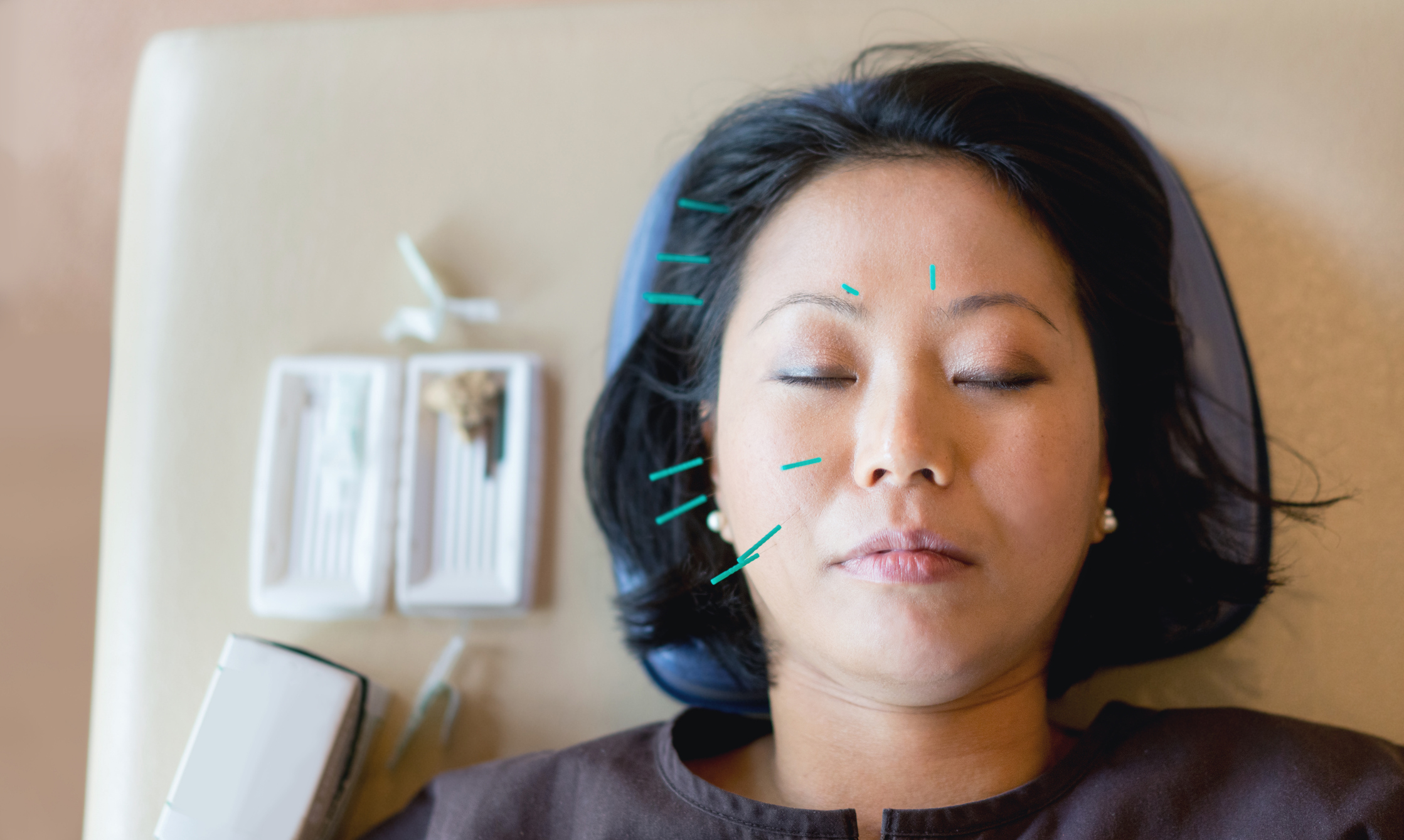 Woman getting acupuncture therapy