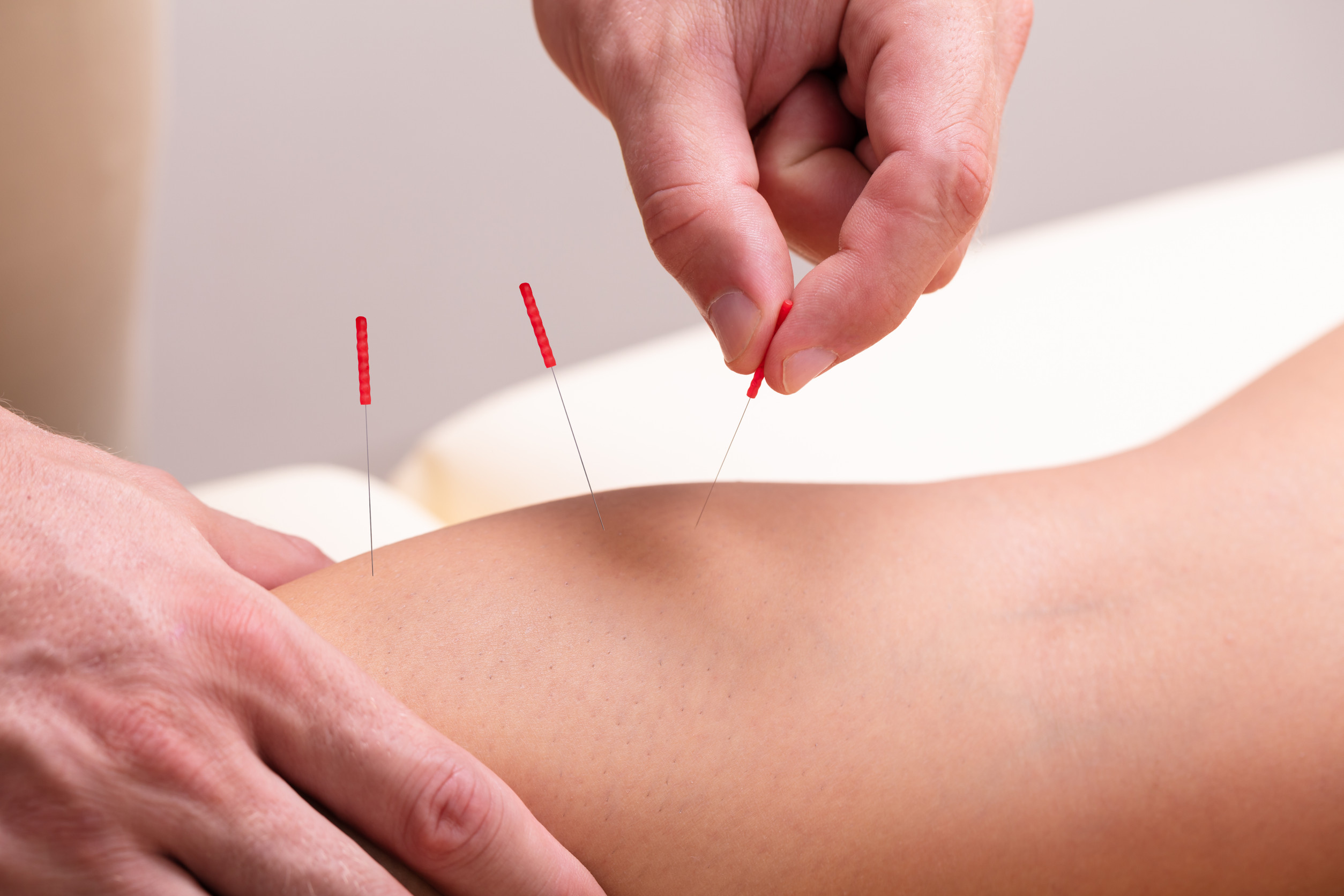 Therapist Giving Acupuncture Treatment On Woman’s Knee